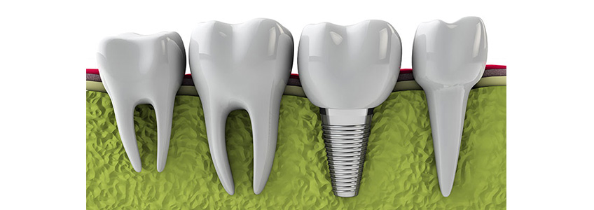Diş Hekimliğinde Kullanılan İmplantlar Ve Özellikleri Mini İmplantlar