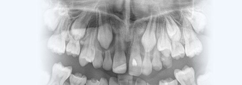 Transizyonal Dentisyon