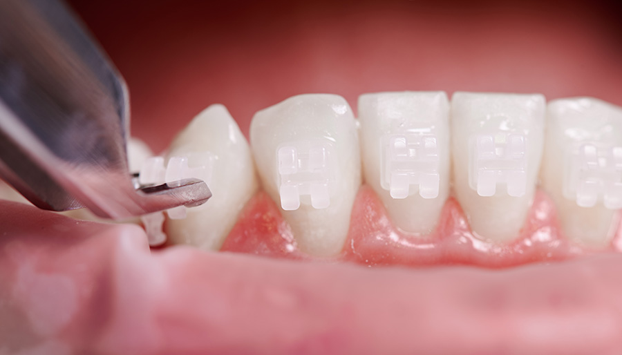 Ortodonti ile Gülüş Tasarımı