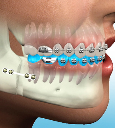 Ağız, Diş ve Çene Cerrahisi ile Gülüş Tasarımı