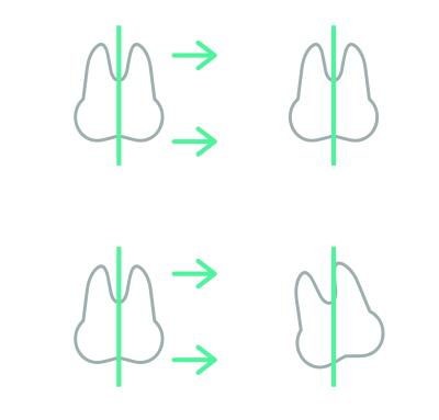 The image illustrates tooth translation, one type of movement in biomechanics of clear aligners