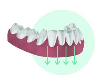 The image shows tooth intrusion, one type of movement in biomechanics of clear aligners