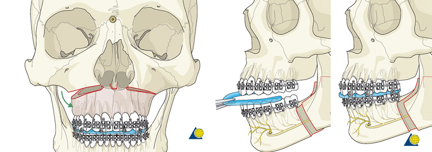 Kombine Cerrahi ve Ortodontik Tedavi
