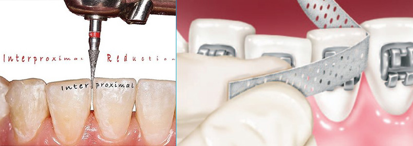 Ortodontide Dişler Arasından Aşındırma