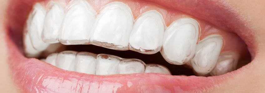 Şeffaf Plaklarla Ortotontik Tedavi (Telsiz Ortodonti)